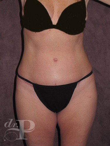 Case--1678 | After True Form Tummy Tuck® 1
