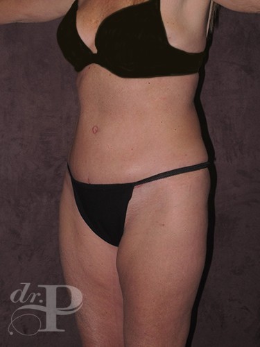 Case--1678 | After True Form Tummy Tuck® 2