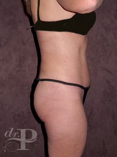 Case--1668 | After Liposuction 3