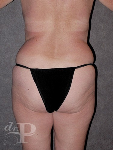 Case--1668 | Before Liposuction 4