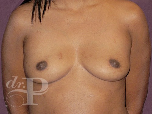 Case--28613 | Before Breast Augmentation 1