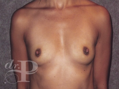 Case--30312 | Before Breast Augmentation 1