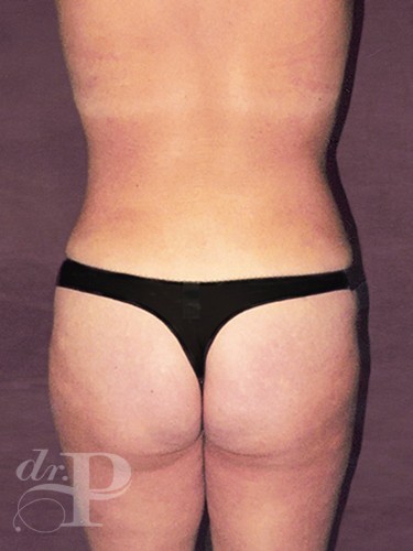 Case--1110 | After True Form Tummy Tuck® 4