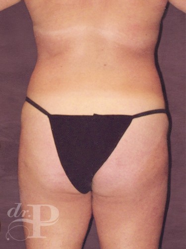 Case--1110 | Before True Form Tummy Tuck® 4