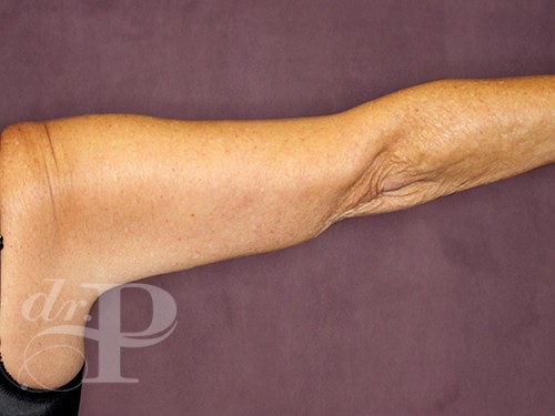 Case--28243 | After Arm Lift 3