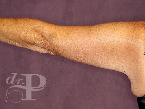 Case--28243 | After Arm Lift 1