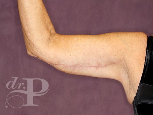 Case--28243 | After Arm Lift 2