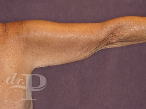 Case--28243 | Before Arm Lift 3