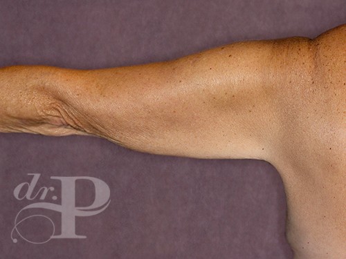 Case--28243 | Before Arm Lift 1
