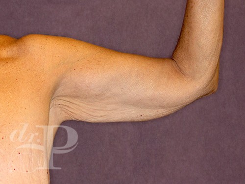 Case--28243 | Before Arm Lift 4