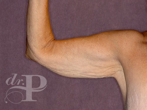 Case--28243 | Before Arm Lift 2
