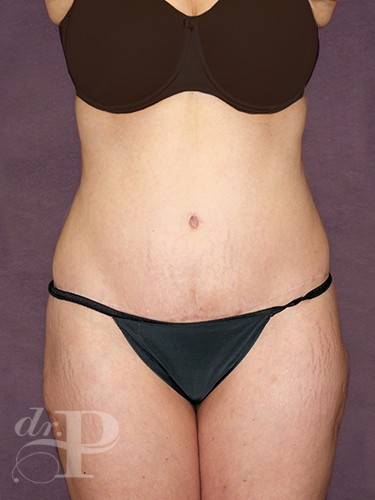 Case--869 | After True Form Tummy Tuck® 1
