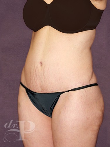 Case--869 | After True Form Tummy Tuck® 2