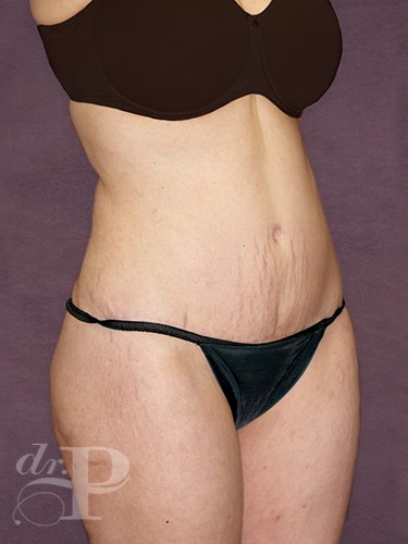 Case--869 | After True Form Tummy Tuck® 4