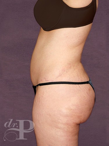 Case--869 | After True Form Tummy Tuck® 3
