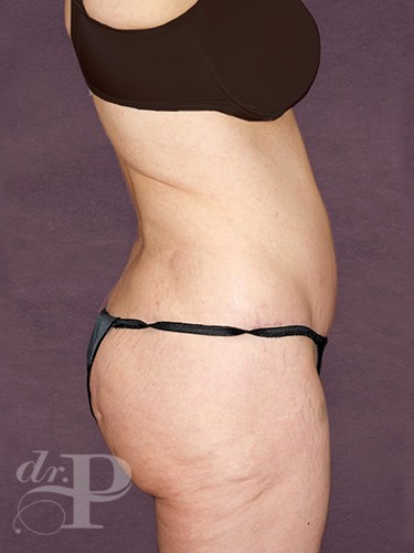 Case--869 | After True Form Tummy Tuck® 5
