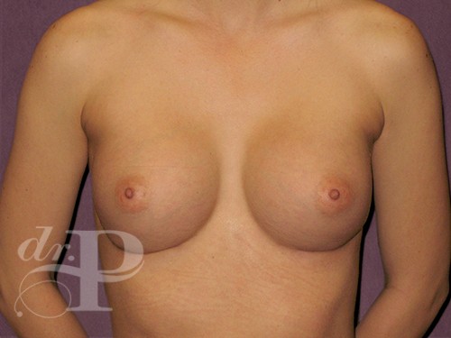 Case--29355 | After Corrective/Revision Breast Implant Surgery 1