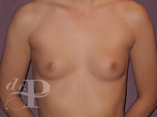 Case--29355 | Before Corrective/Revision Breast Implant Surgery 1