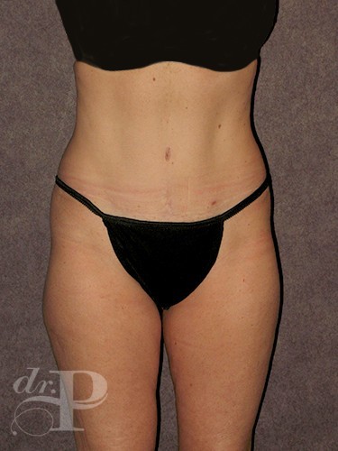 Case--1646 | After True Form Tummy Tuck® 1