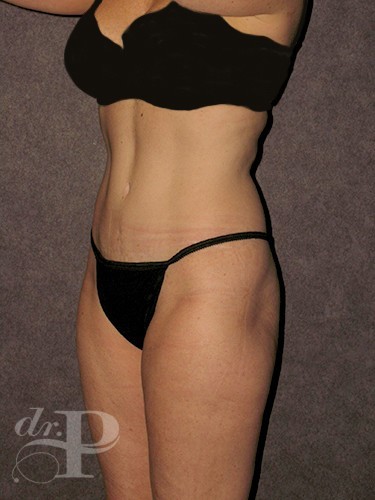 Case--1646 | After True Form Tummy Tuck® 2