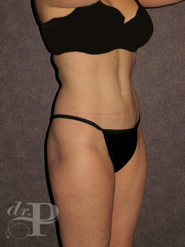Case--1646 | After True Form Tummy Tuck® 3