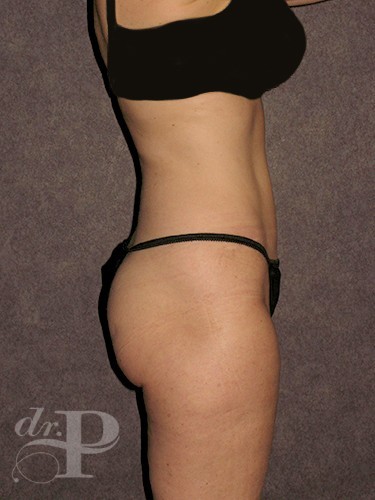 Case--1646 | After True Form Tummy Tuck® 4