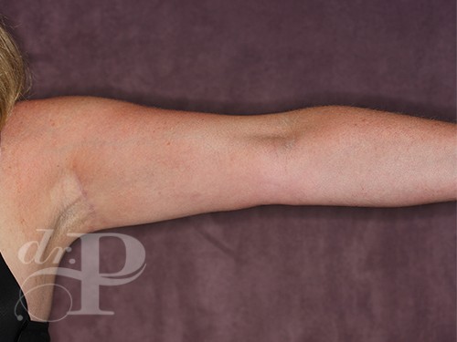 Case--28228 | After Arm Lift 2