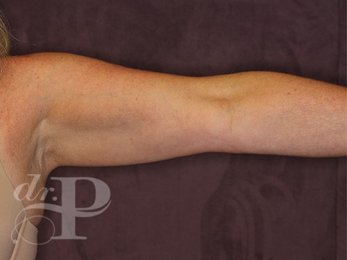 Case--28228 | Before Arm Lift 2