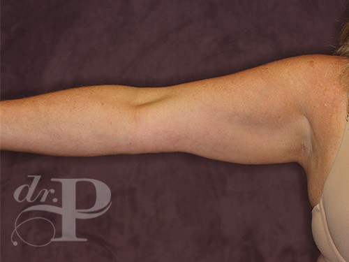 Case--28228 | Before Arm Lift 1