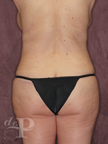 Case--1060 | After Liposuction 4