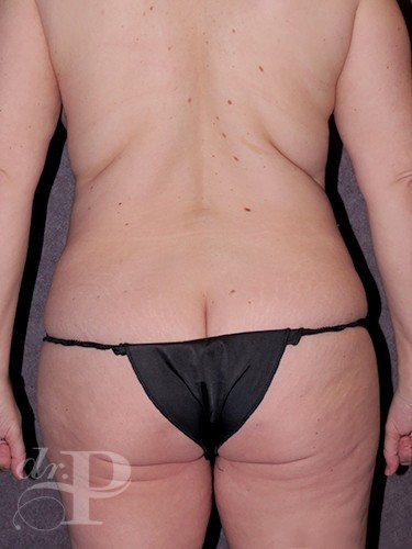 Case--1070 | Before Liposuction 4