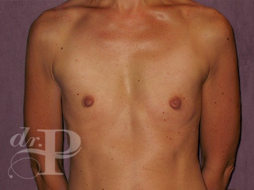 Case--30163 | Before Breast Augmentation 1