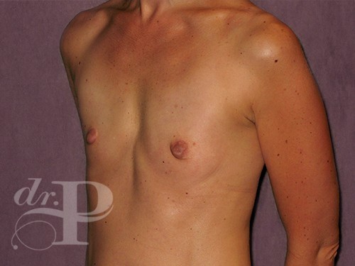 Case--30163 | Before Breast Augmentation 2