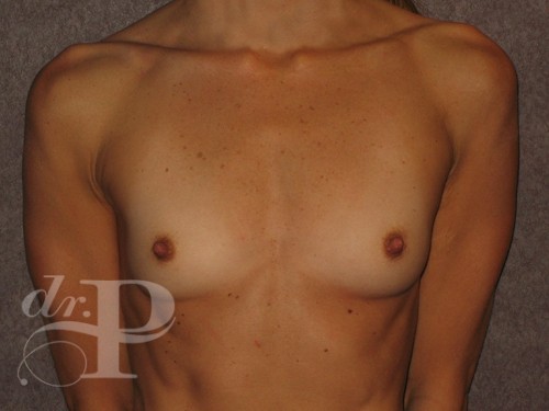 Case--30537 | Before Breast Augmentation 1