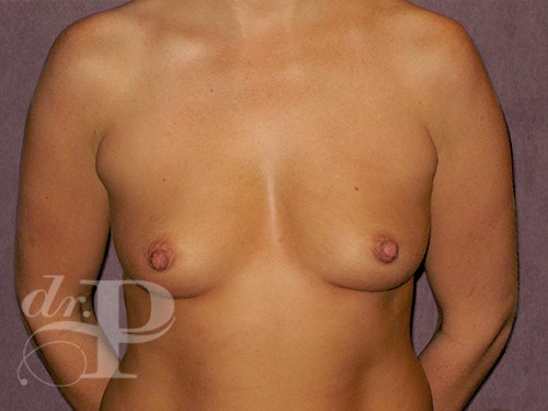 Case--27997 | Before Breast Augmentation 1