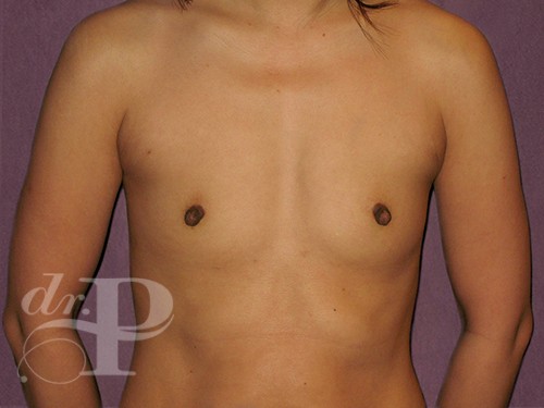 Case--29724 | Before Breast Augmentation 1