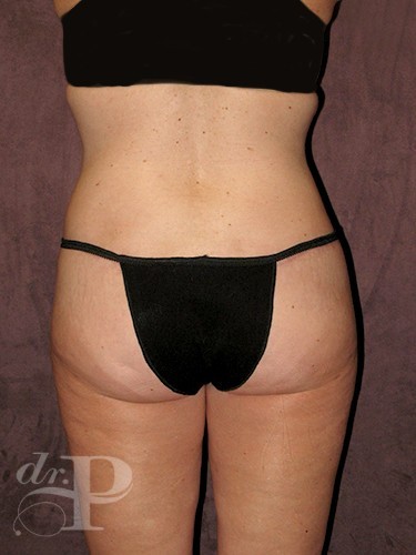 Case--29703 | After True Form Tummy Tuck® with Lower Body Lift (Buttock Lift) 4