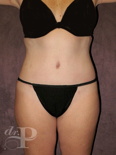 Case--29703 | After True Form Tummy Tuck® with Lower Body Lift (Buttock Lift) 1