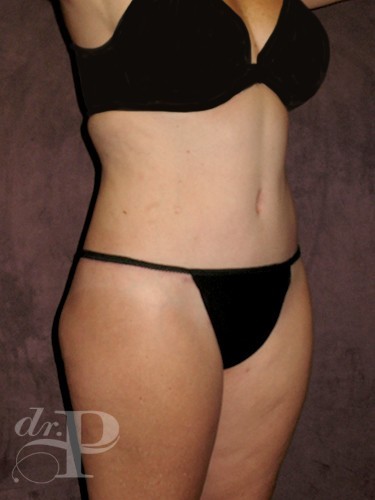Case--1666 | After True Form Tummy Tuck® 3