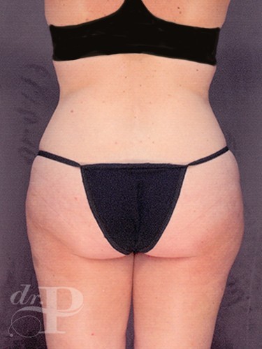 Case--1656 | Before Liposuction 4