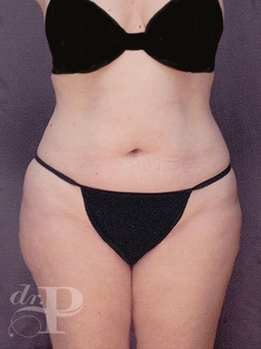 Case--1656 | Before Liposuction 1