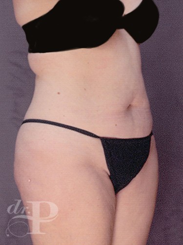 Case--29703 | Before True Form Tummy Tuck® with Lower Body Lift (Buttock Lift) 3