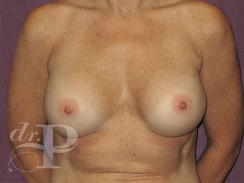 Case--29347 | After Corrective/Revision Breast Implant Surgery 1