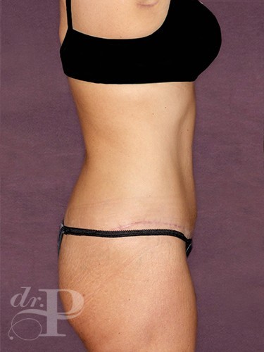 Case--29922 | After Lower Body Lift (Buttock Lift) 3
