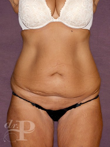 Case--29931 | Before True Form Tummy Tuck® with Lower Body Lift (Buttock Lift) 1
