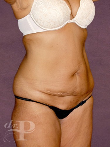 Case--975 | Before True Form Tummy Tuck® 2