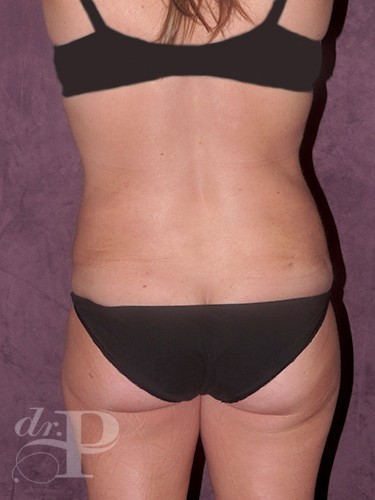 Case--1231 | After Liposuction 4