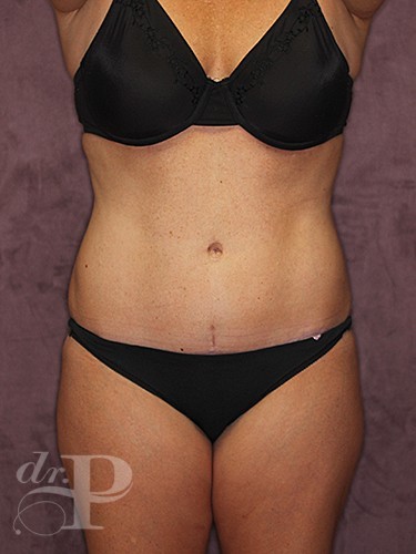 Case--1231 | After Liposuction 1