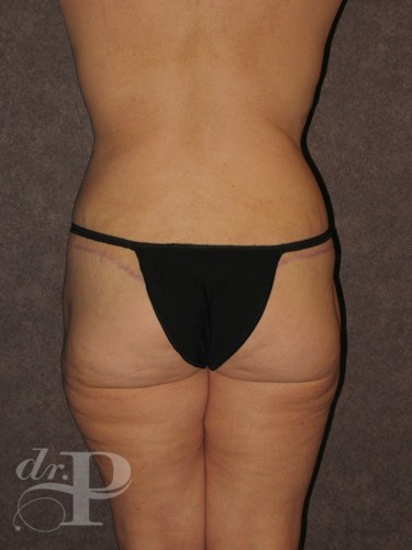 Case--28980 | After Lower Body Lift (Buttock Lift) 4
