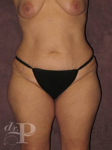 Case--1874 | Before True Form Tummy Tuck® 1